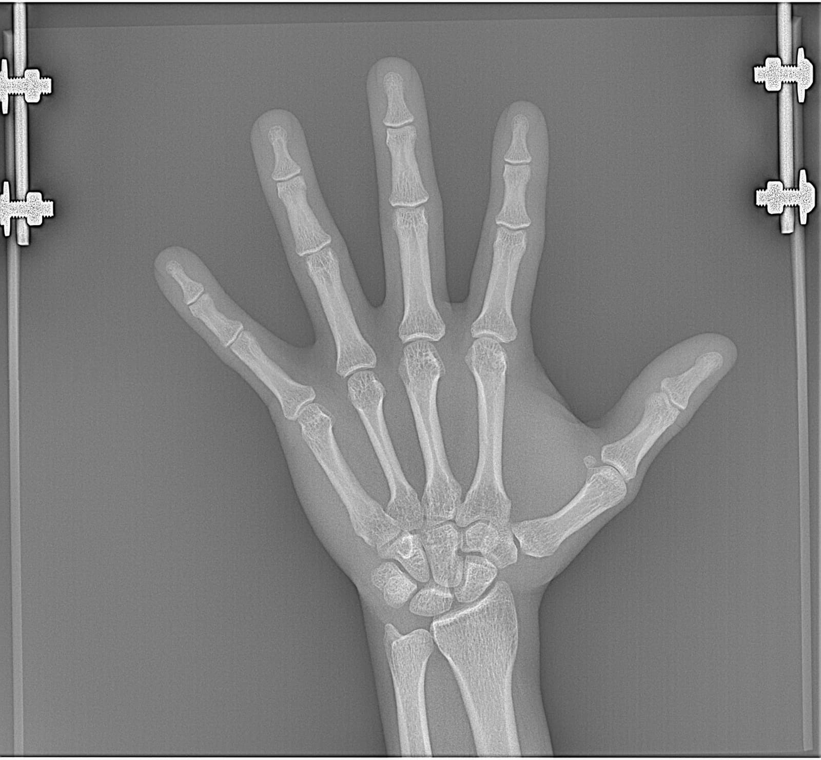 Radiografía frontal de una mano