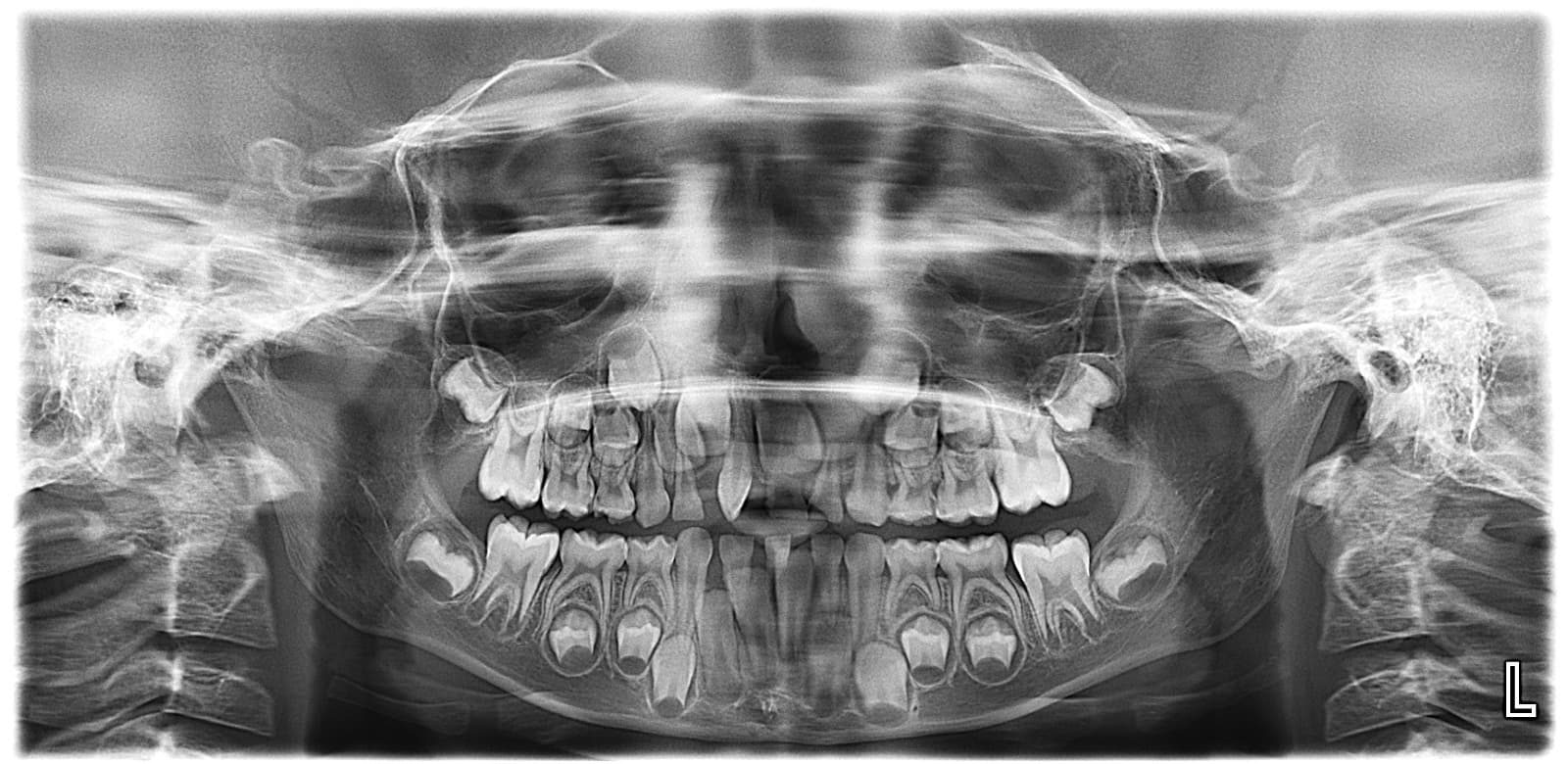 Radiografía panorámica de la dentición