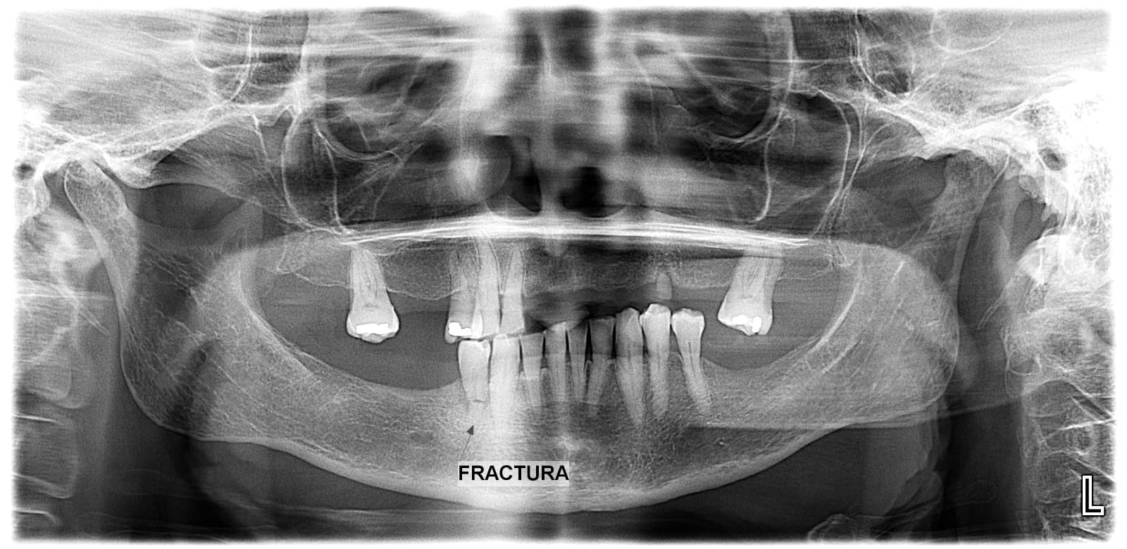 Radiografía panorámica de mandíbula