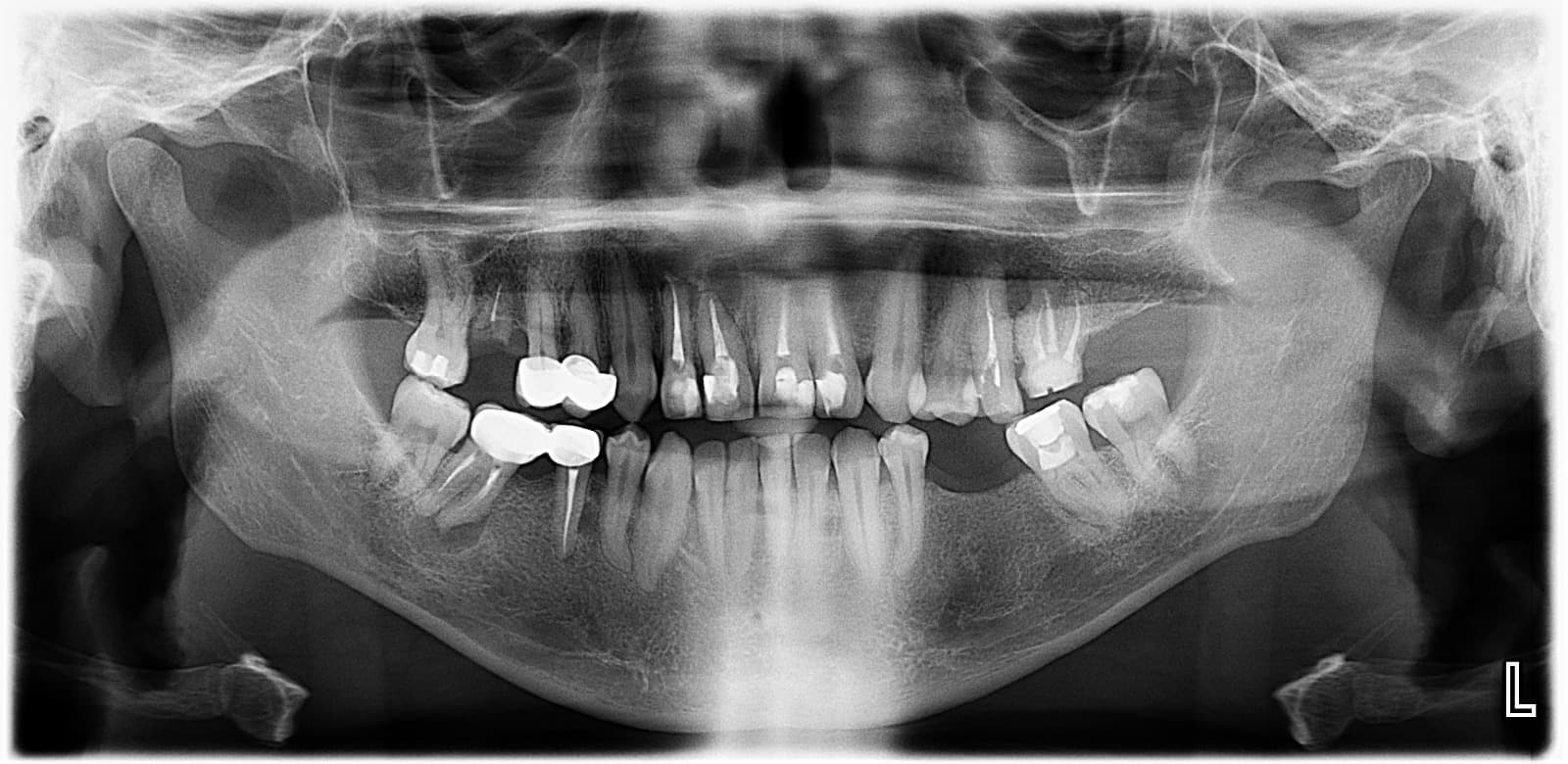 Radiografía panorámica con restauraciones dentales