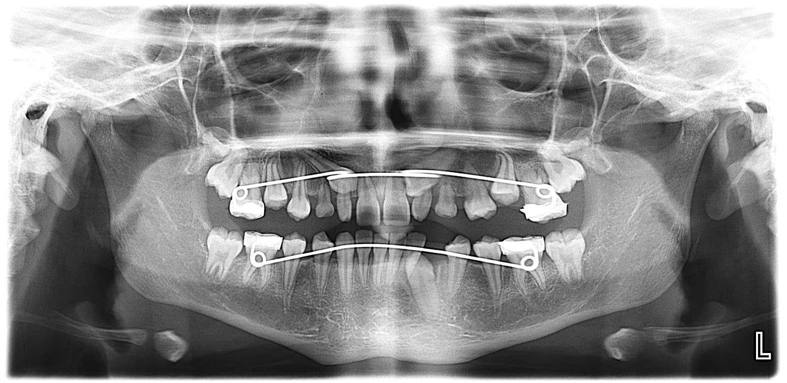 Radiografía panorámica con aparatología de ortodoncia